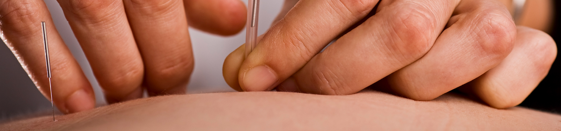 Dry Needling