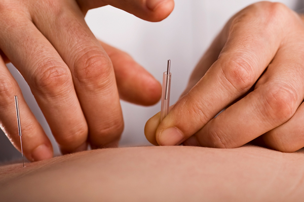 dry_needling