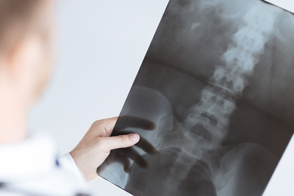 osteoprosis osteoprosis